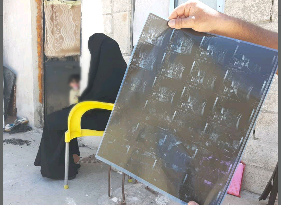 شابة تعاني من آلام في ظهرها