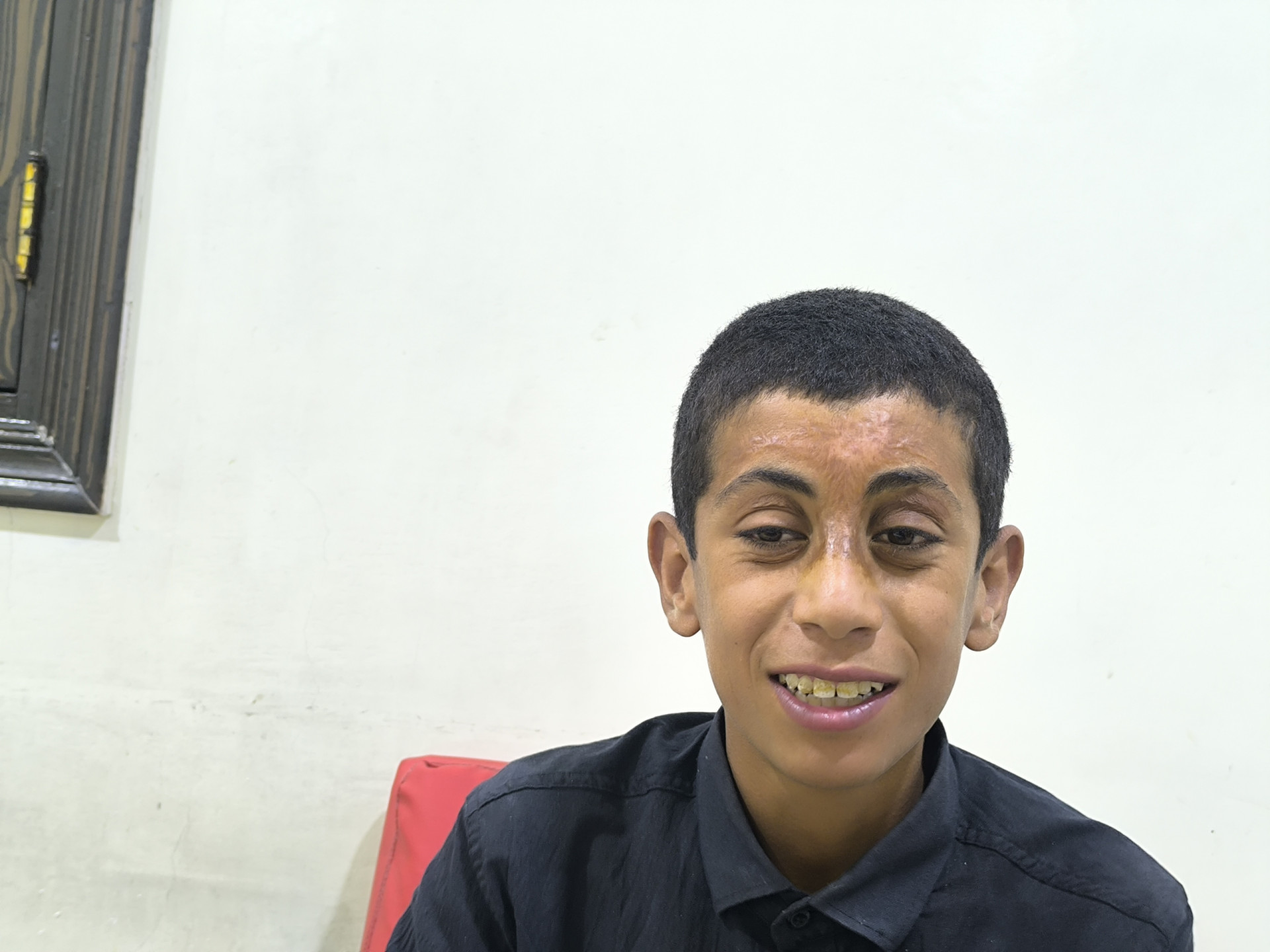 طفلٌ بحروق شديدة