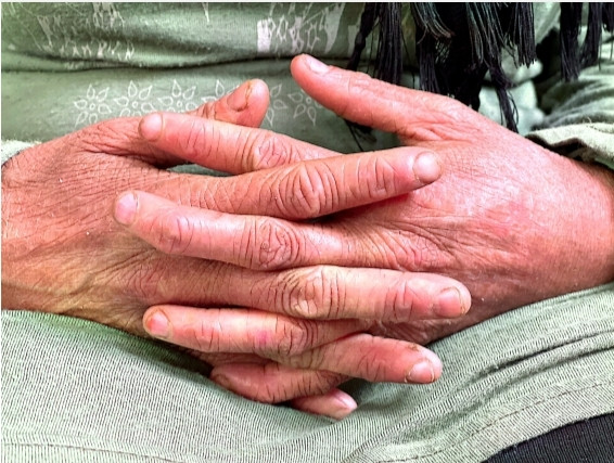 Helana suffers from a chronic condition