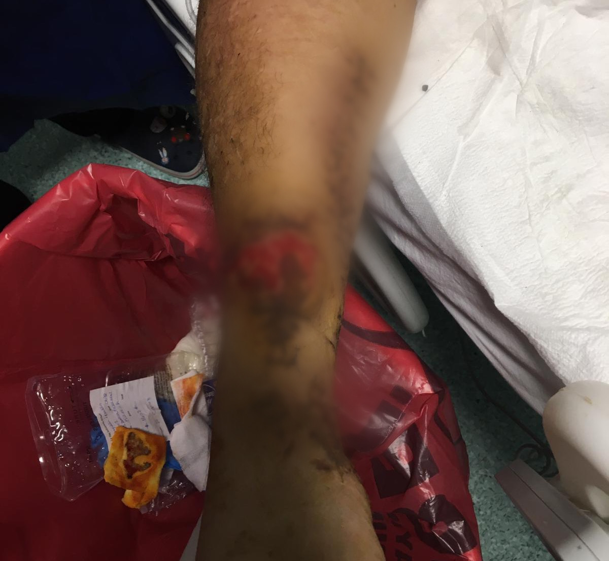 Severe burns throughout his body and kidney failure
