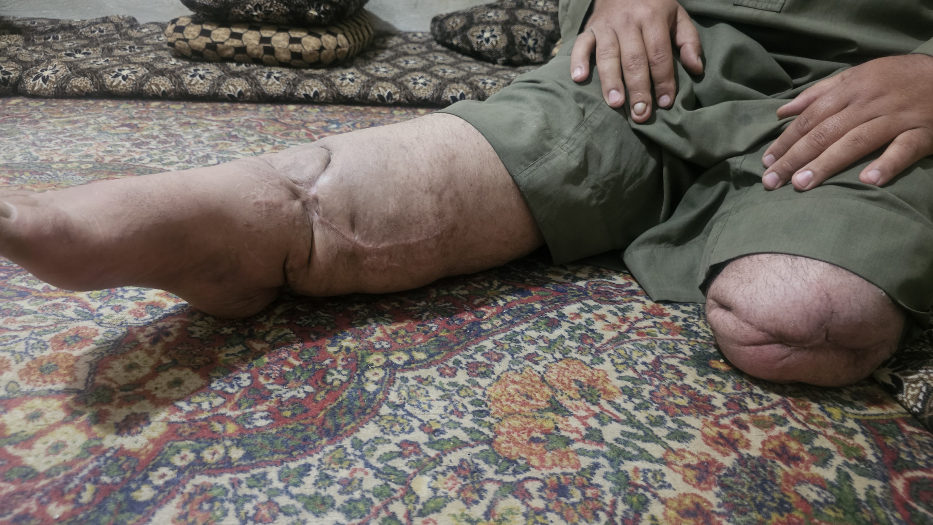 An Amputated Leg and Mouths Waiting for Bread