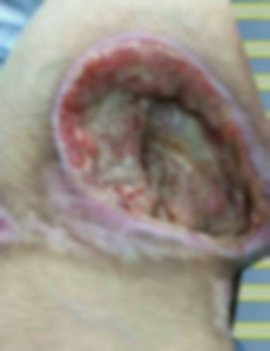 A child suffering from hemiplegia