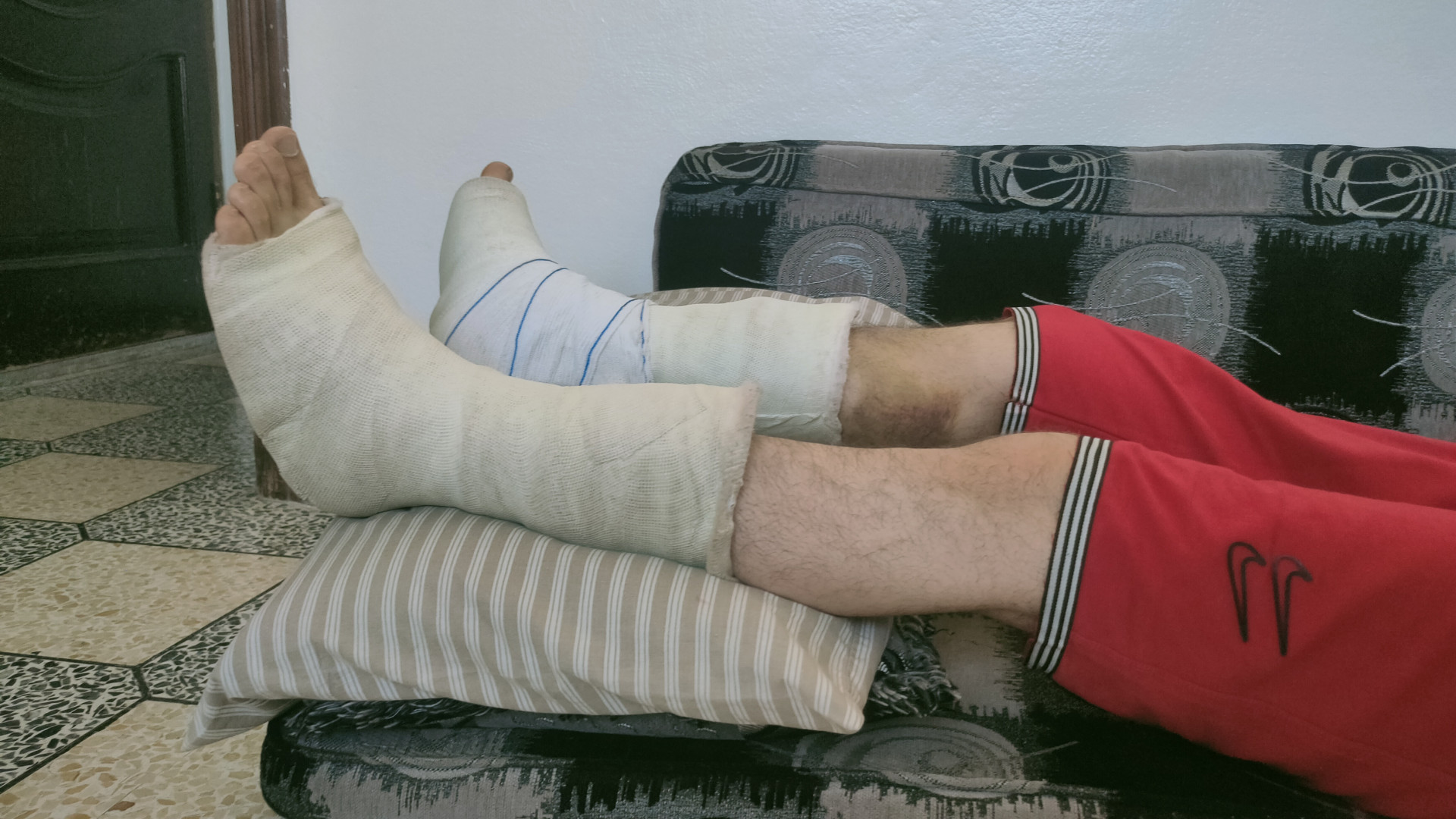 Both of his feet were broken while trying to make a living