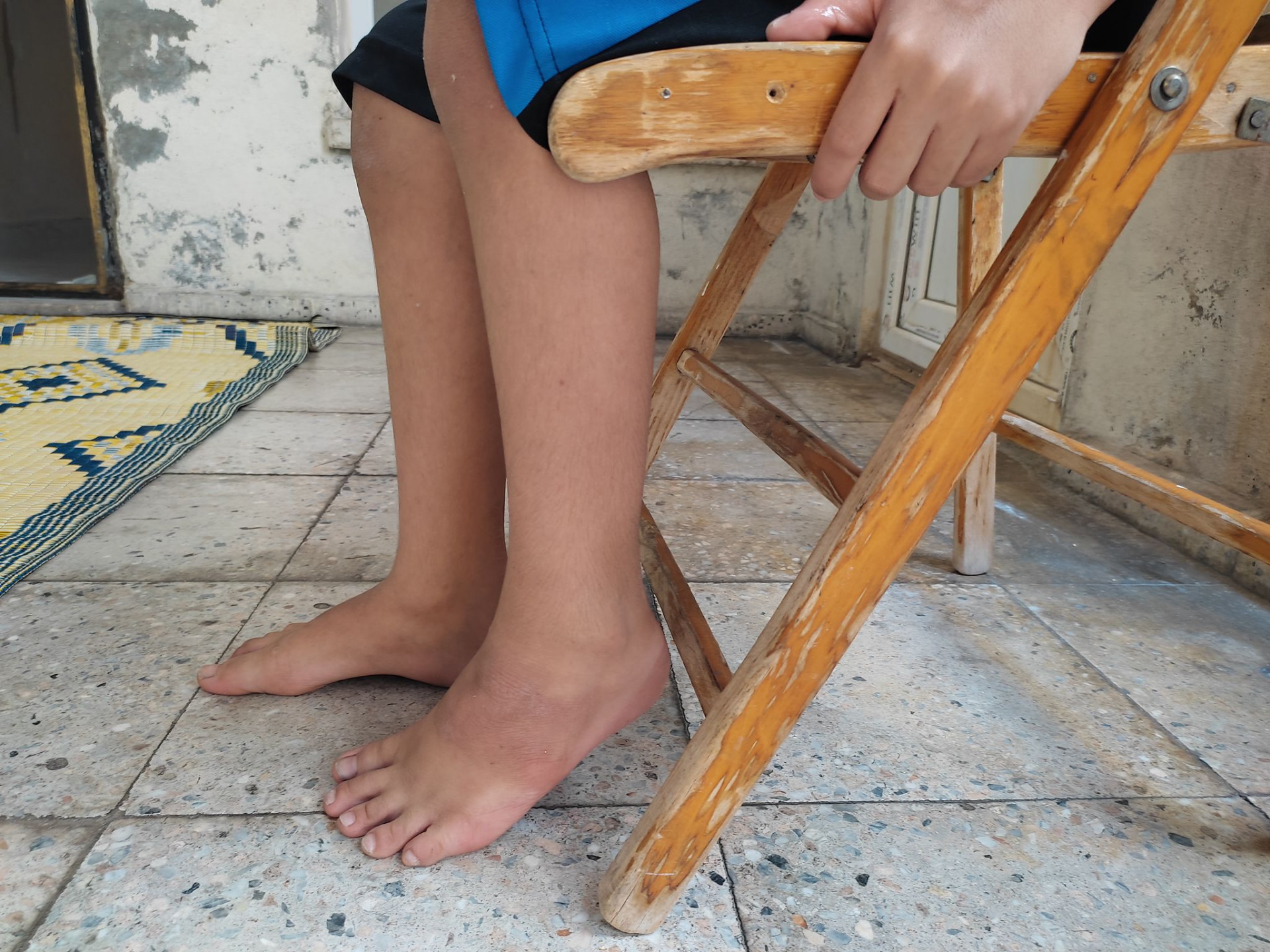 He suffers from brain atrophy and stays at home due to the reactions of people around!