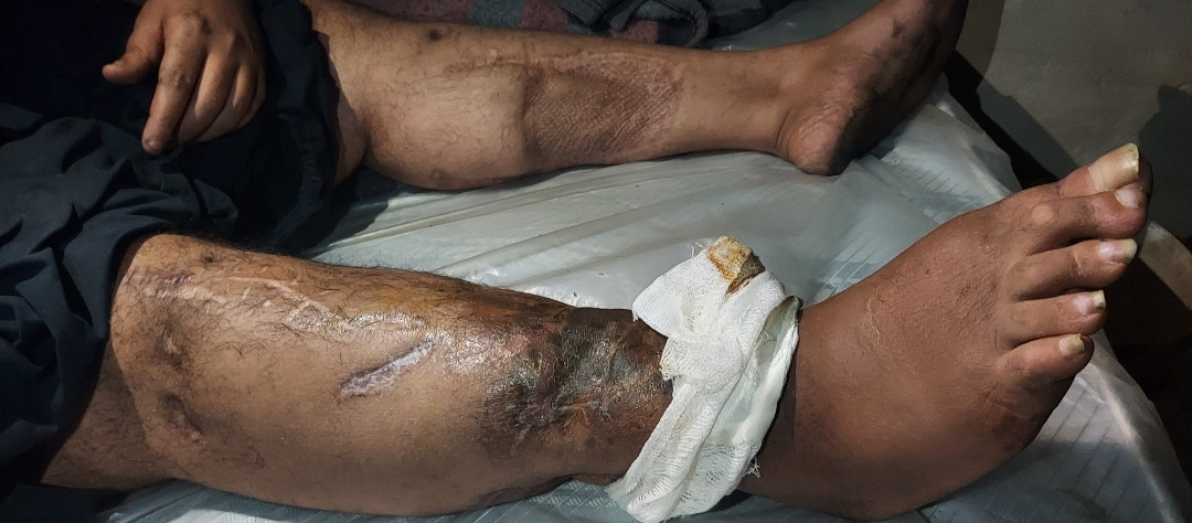 Nizar lost his family, his only breadwinner and needs support to get treated!