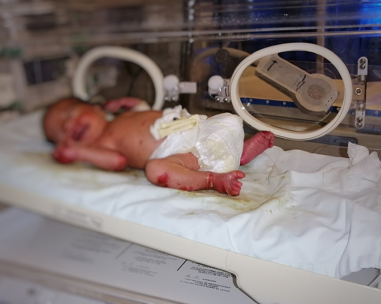Three twins lives in poor conditions
