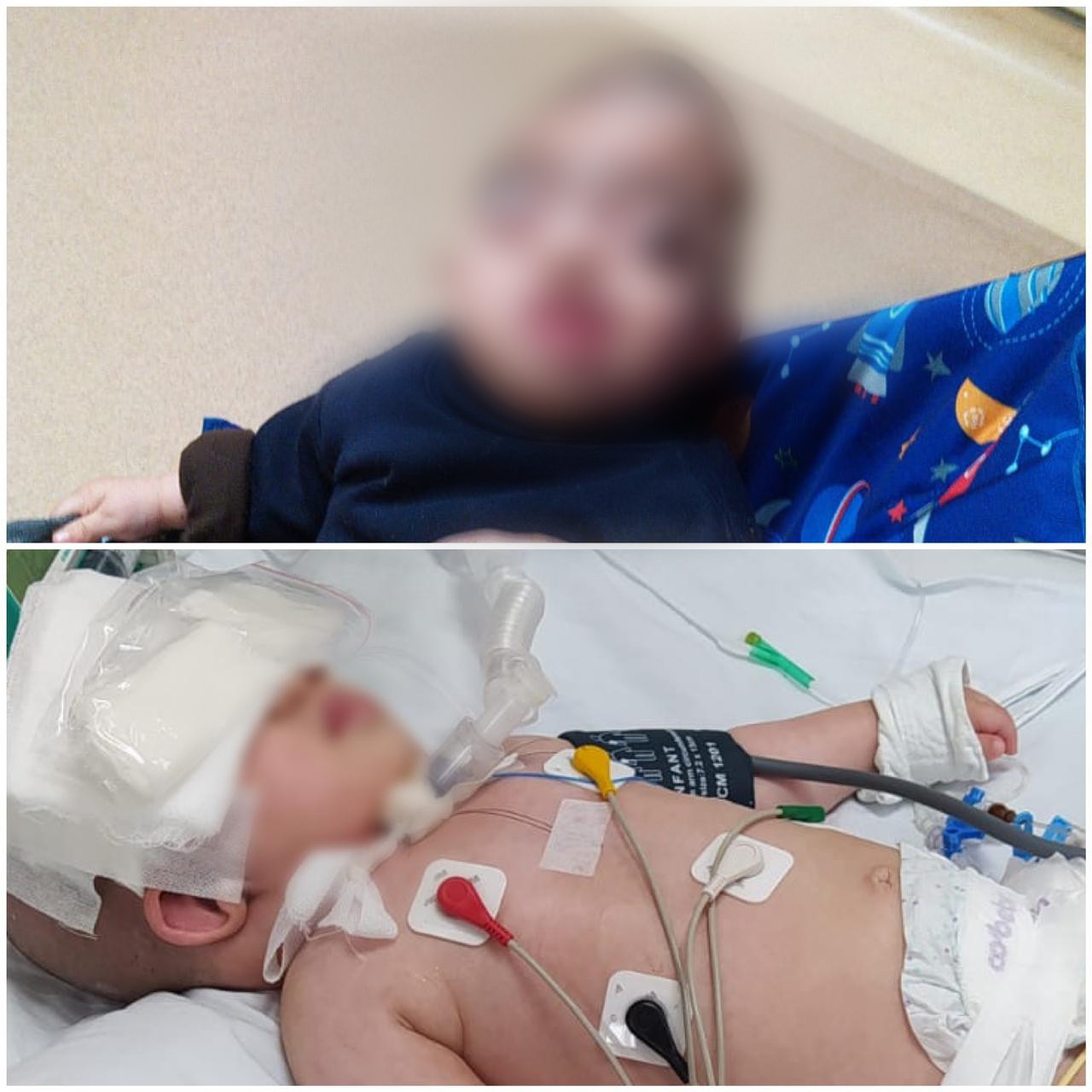 Mohammad suffers from skull deformation and respiratory occlusion