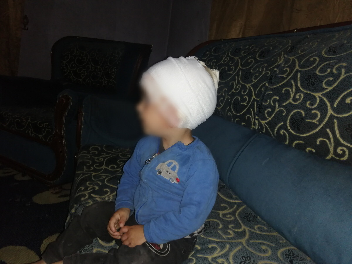 Kotaiba is suffering from a boiling oil burn and needs your help to complete his treatment
