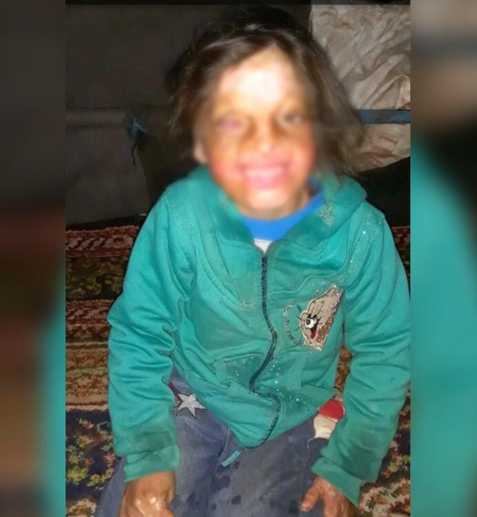 الطفلة إلهام وحروق وجهها
