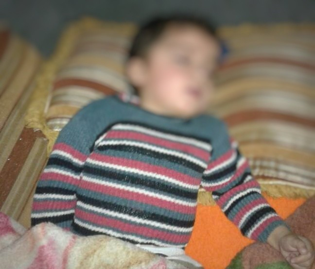 A child with congenital cerebral atrophy