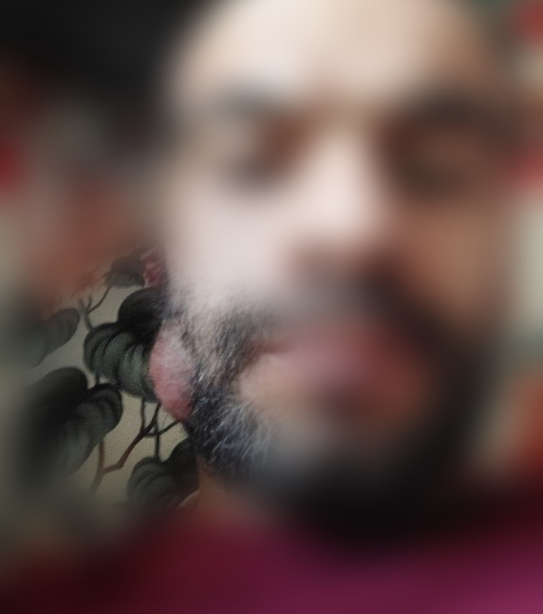 Ahmad is living in fear due to a mass in his cheek that requires resection and biopsy!