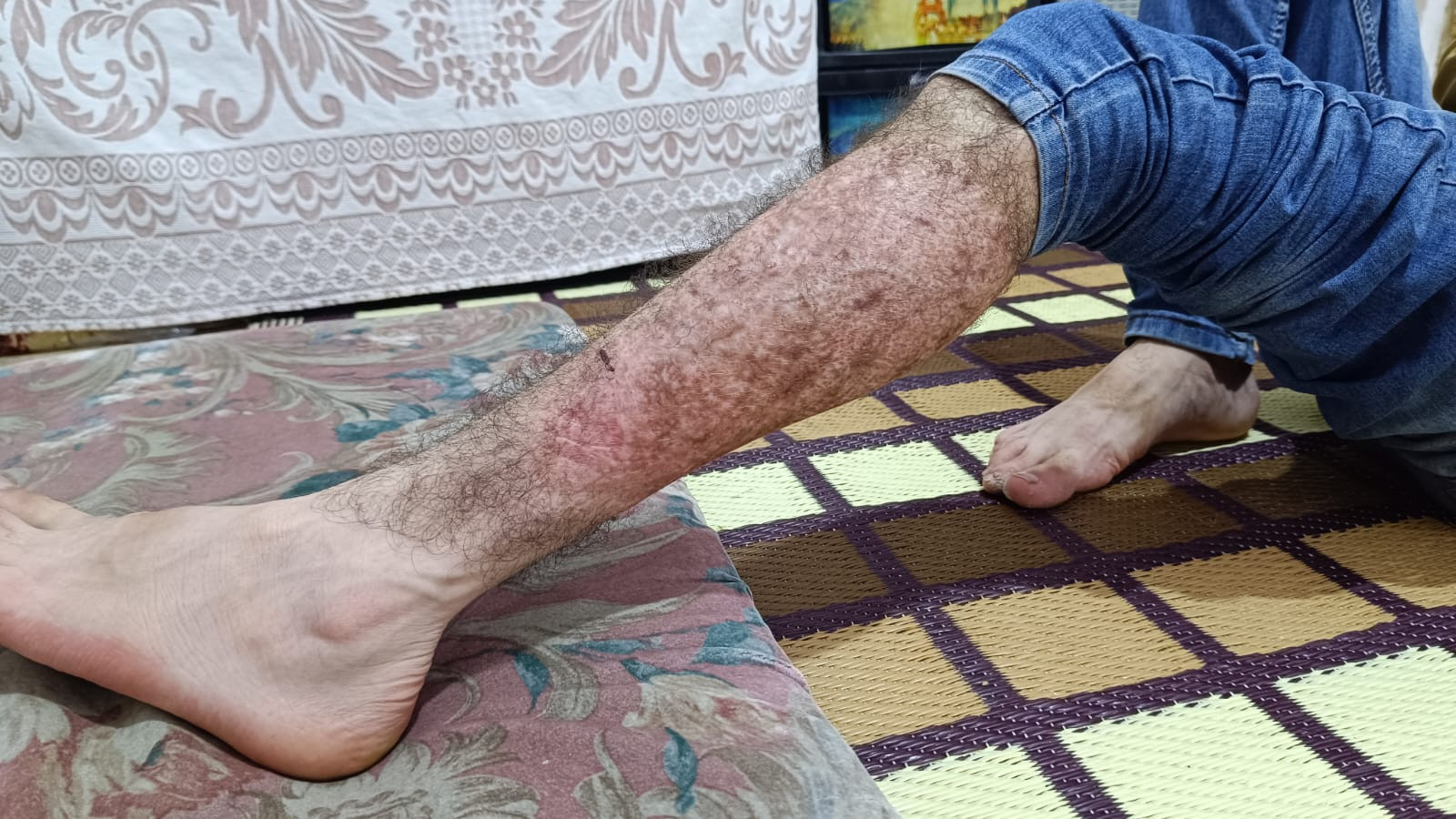 A skin disease poses a threat to Muhammad’s mental health.