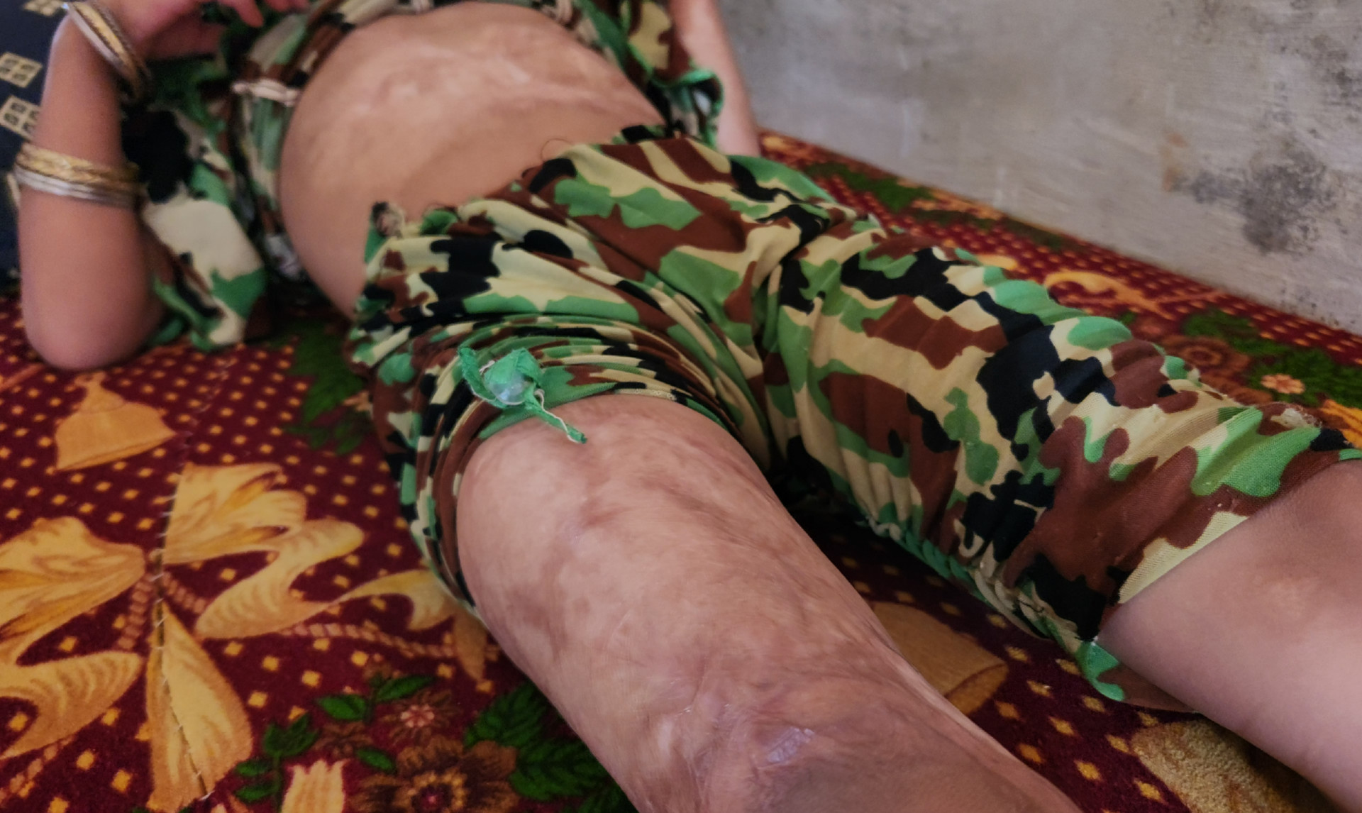 A little child suffering from severe pain and burning scars