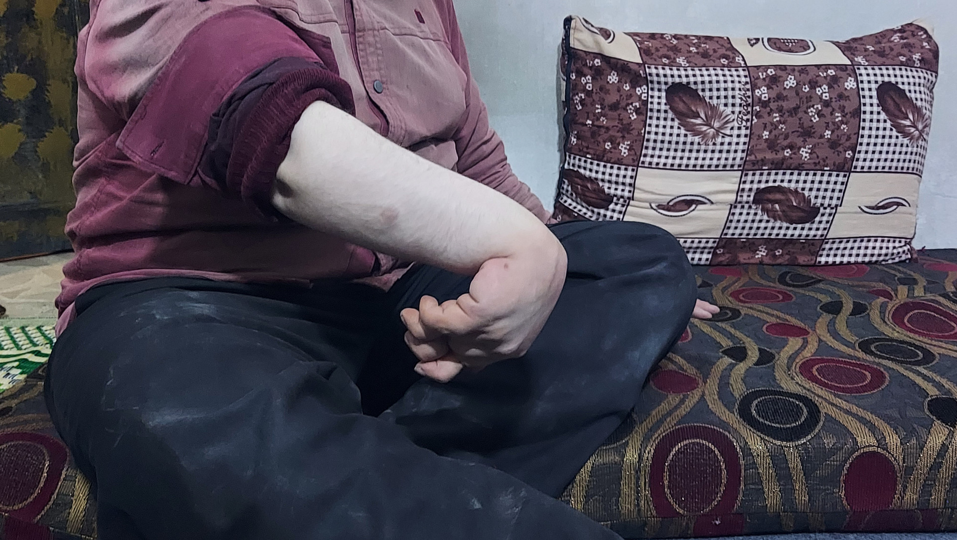 ضمور عضلي منذ الطفولة