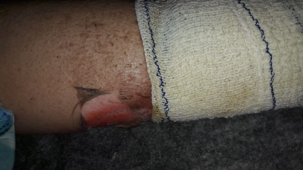 An elderly woman suffer gangrene
