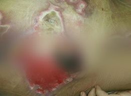 A refugee in need for treatment expenses