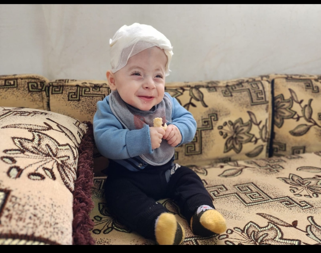Omar is a baby who was suffers from craniosynostosis!