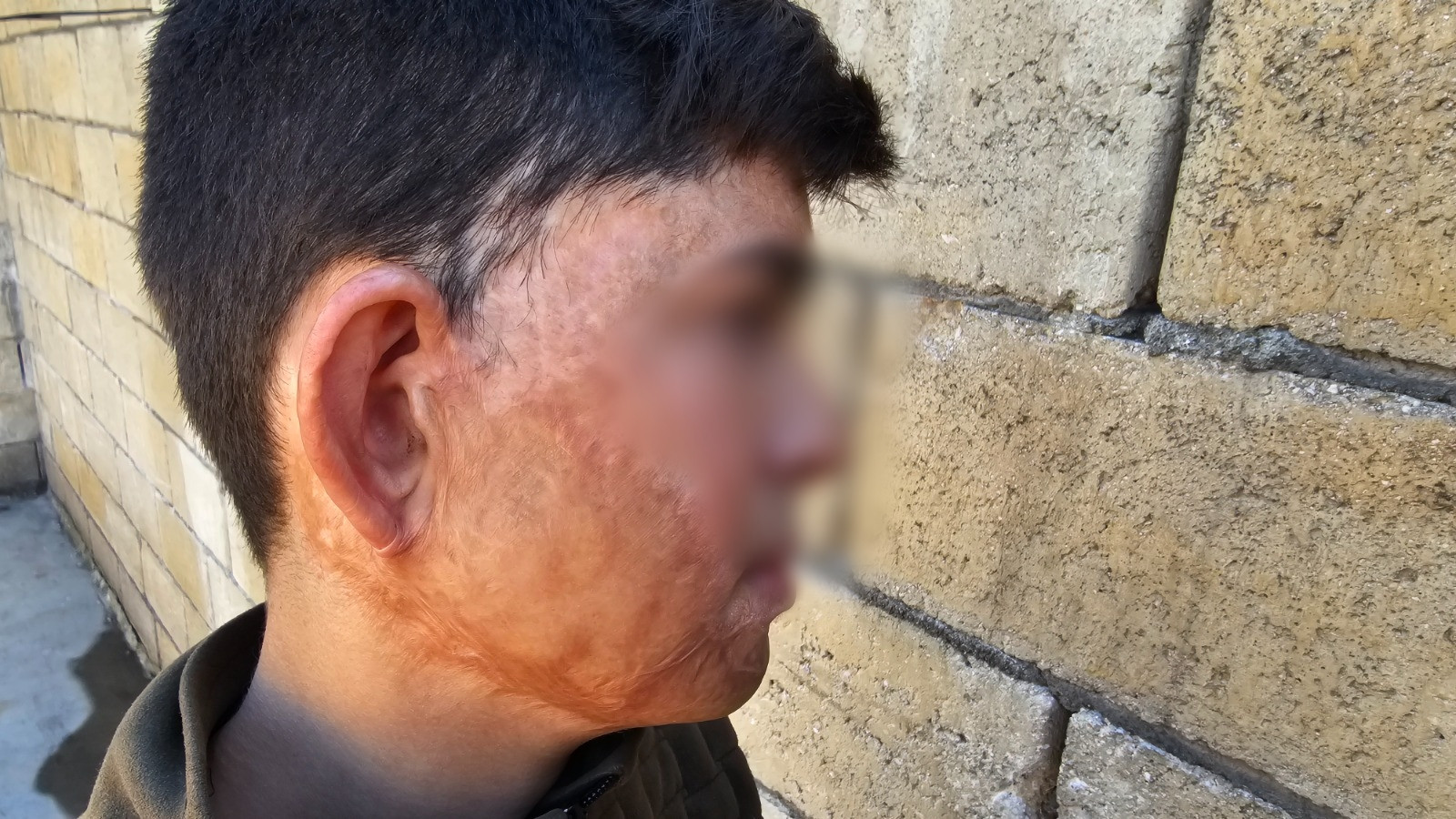 Mohammed has a child who was burned on the face and needs assistance