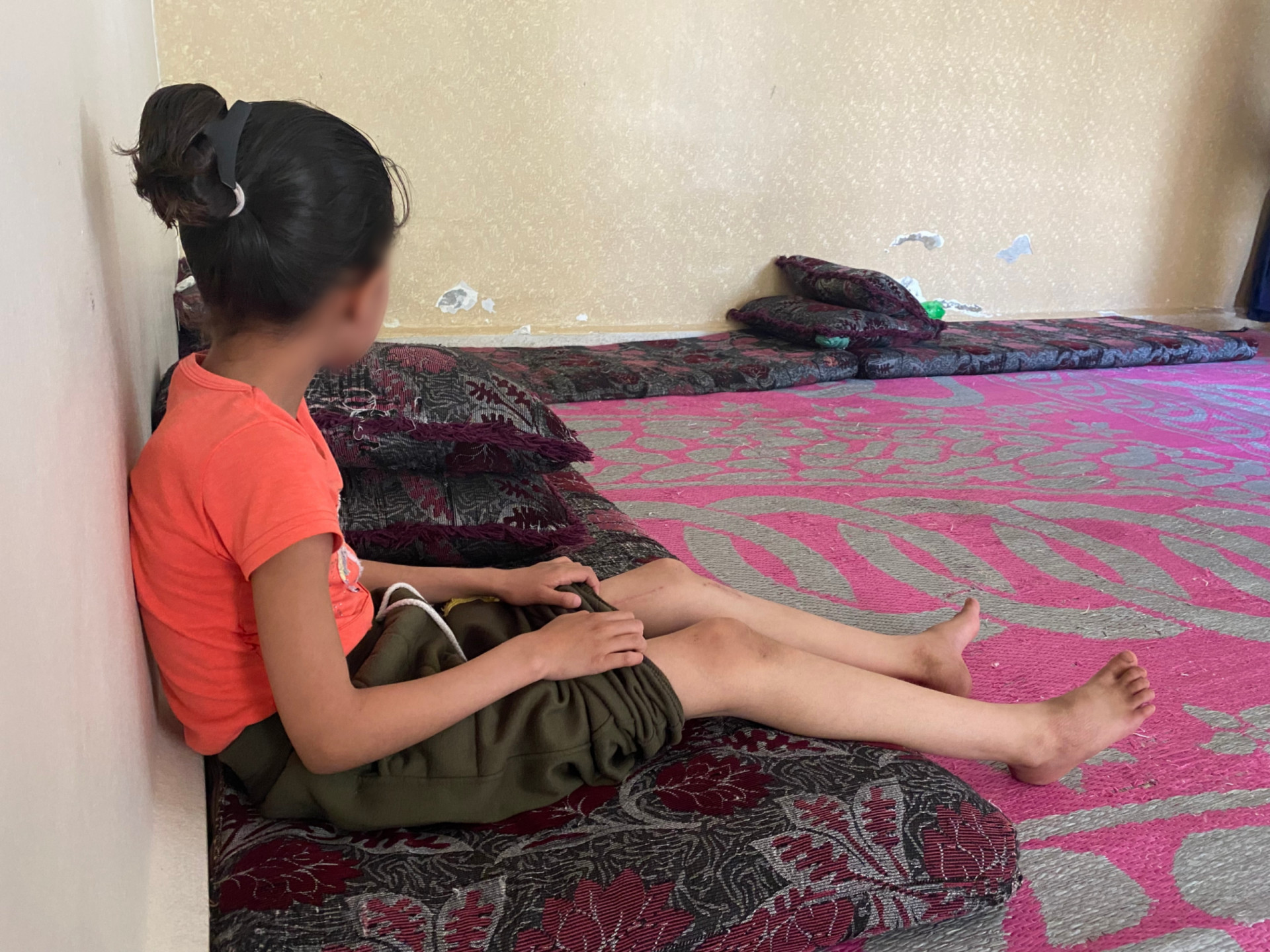 Sarah suffers from congenital hip dislocation