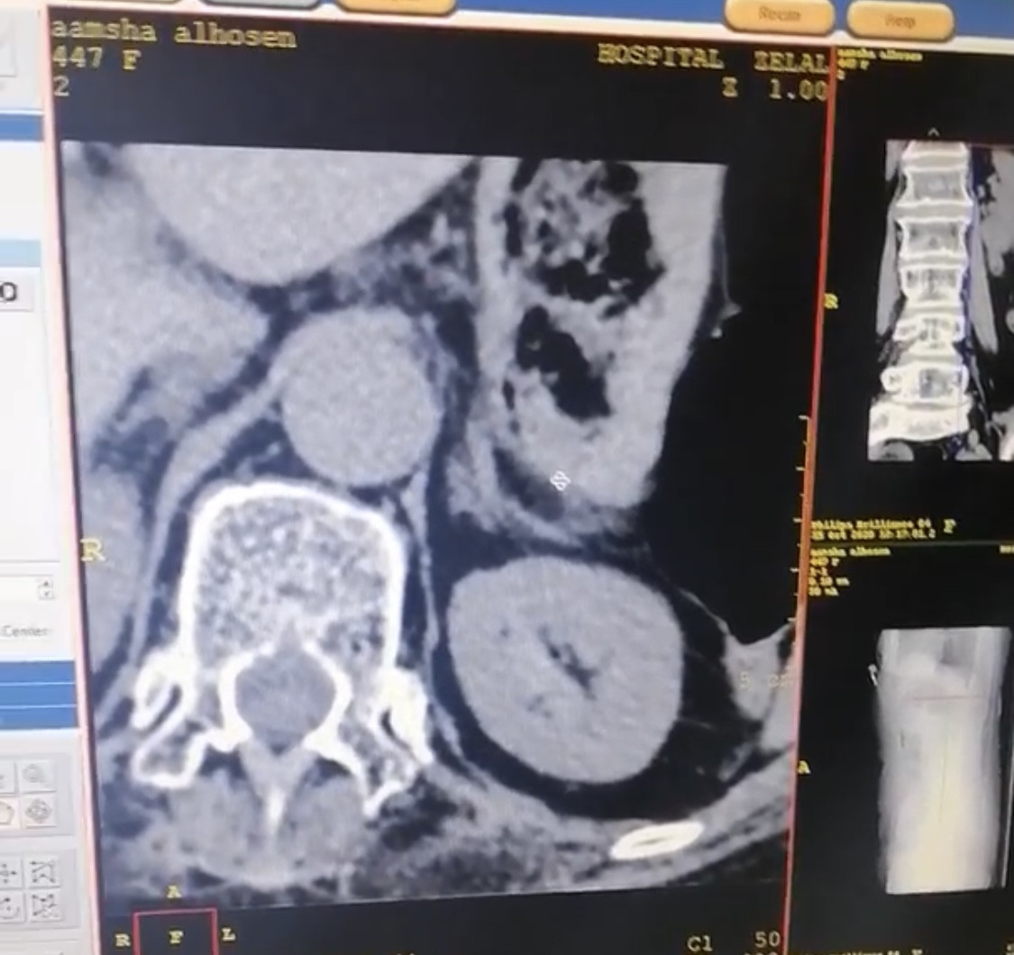 Nahida suffers from hypertension and needs urgent treatment