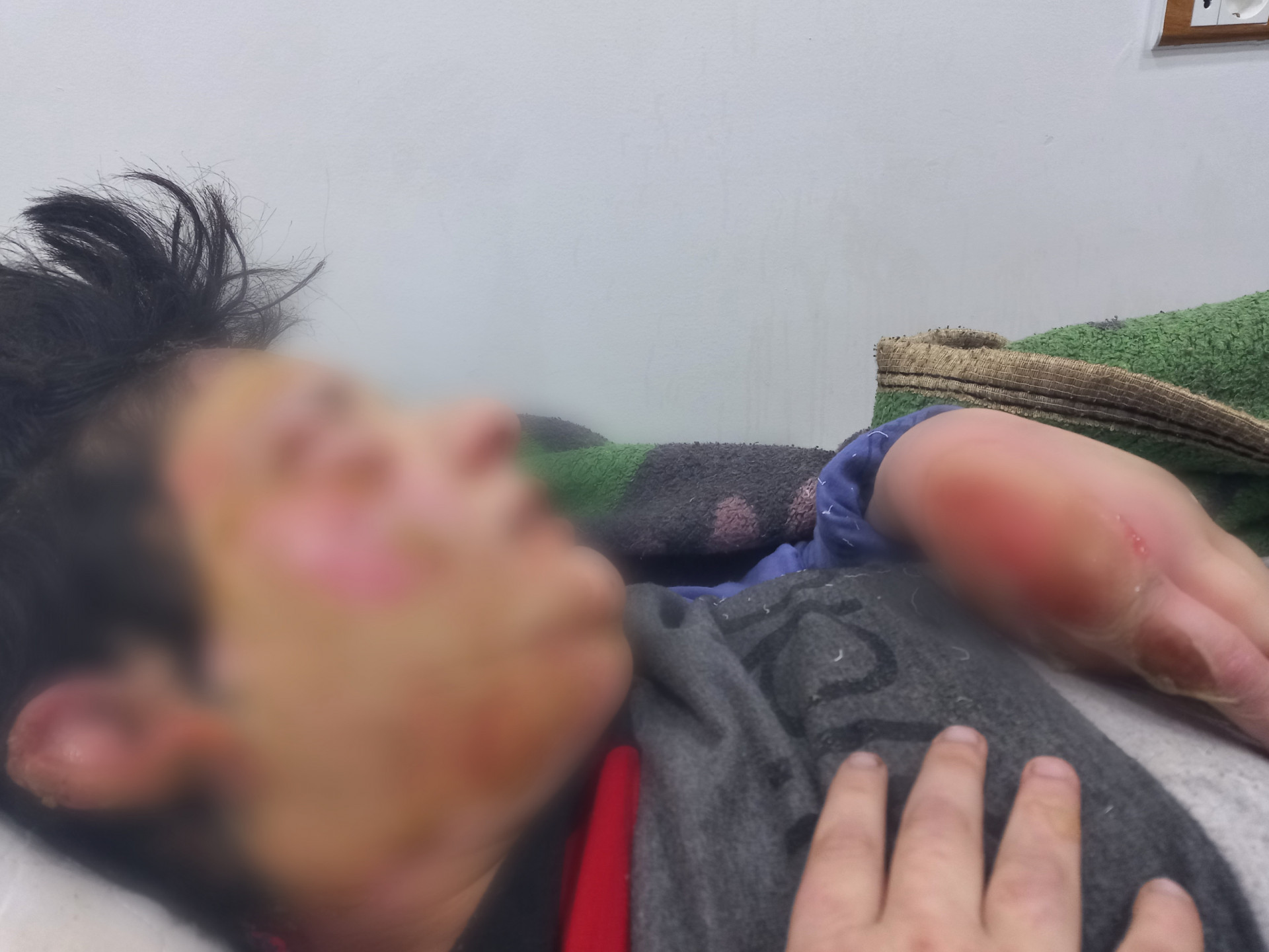 Raghad is with facial burns due to a fire accident