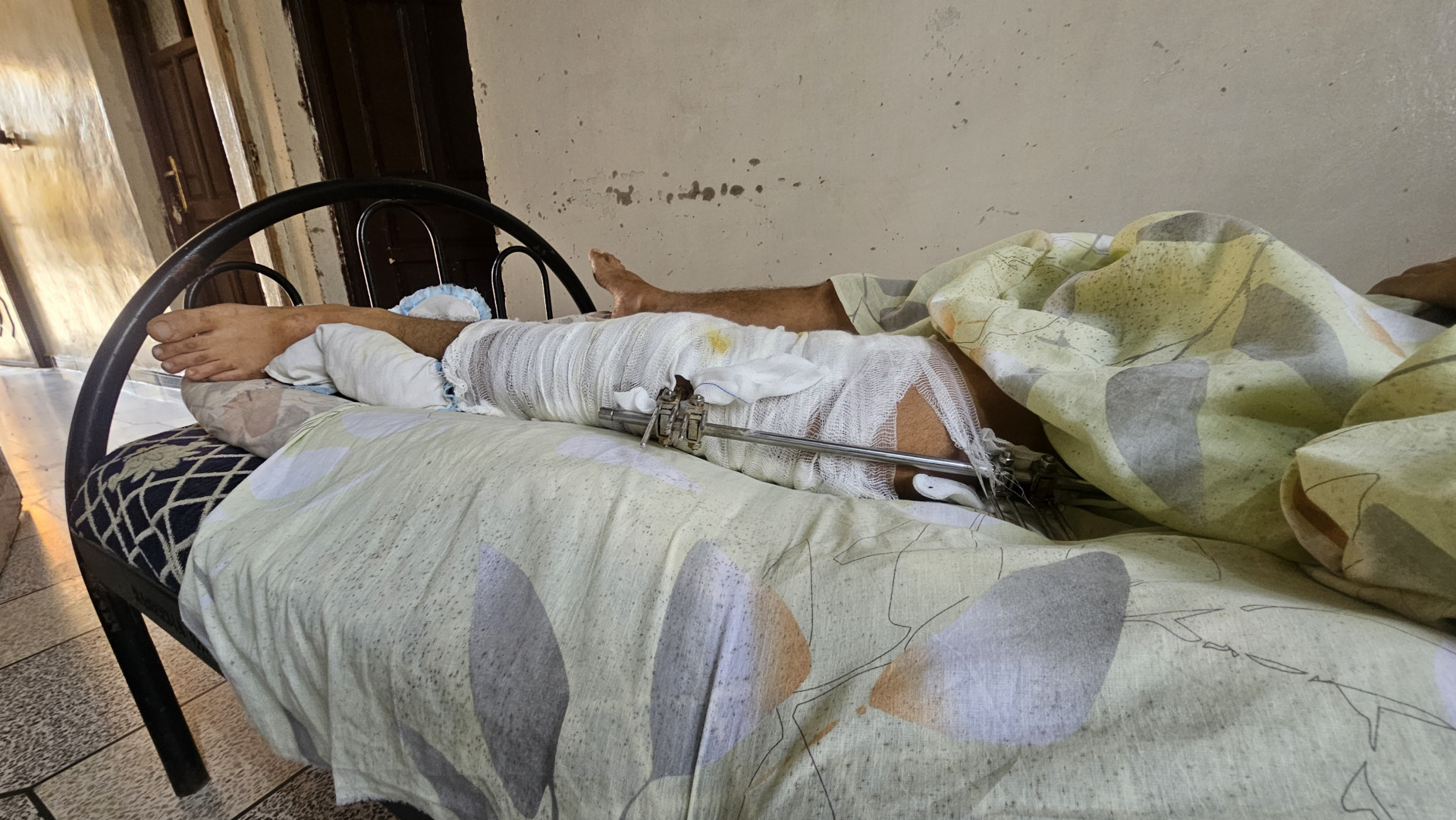 A child whom his bones were crashed by shrapnel