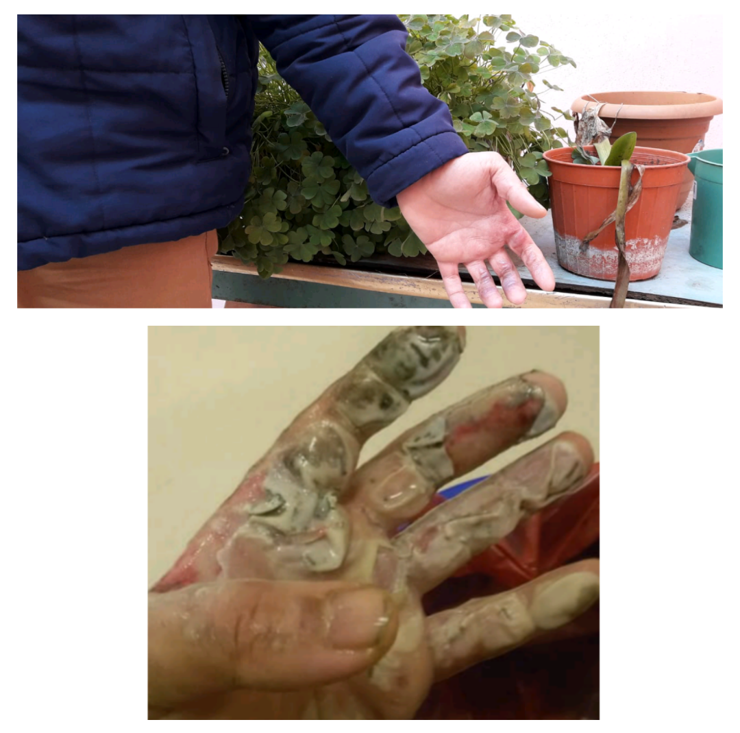 A family whose provider suffers from hand burns