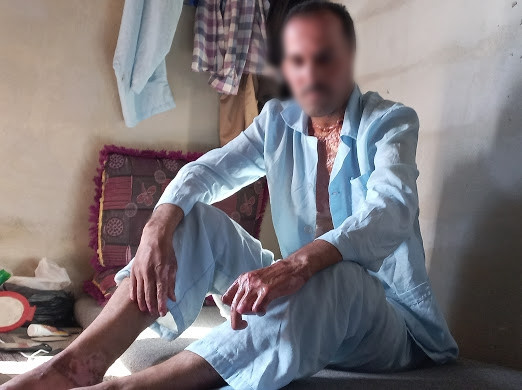 He had burns while working and he needs your help
