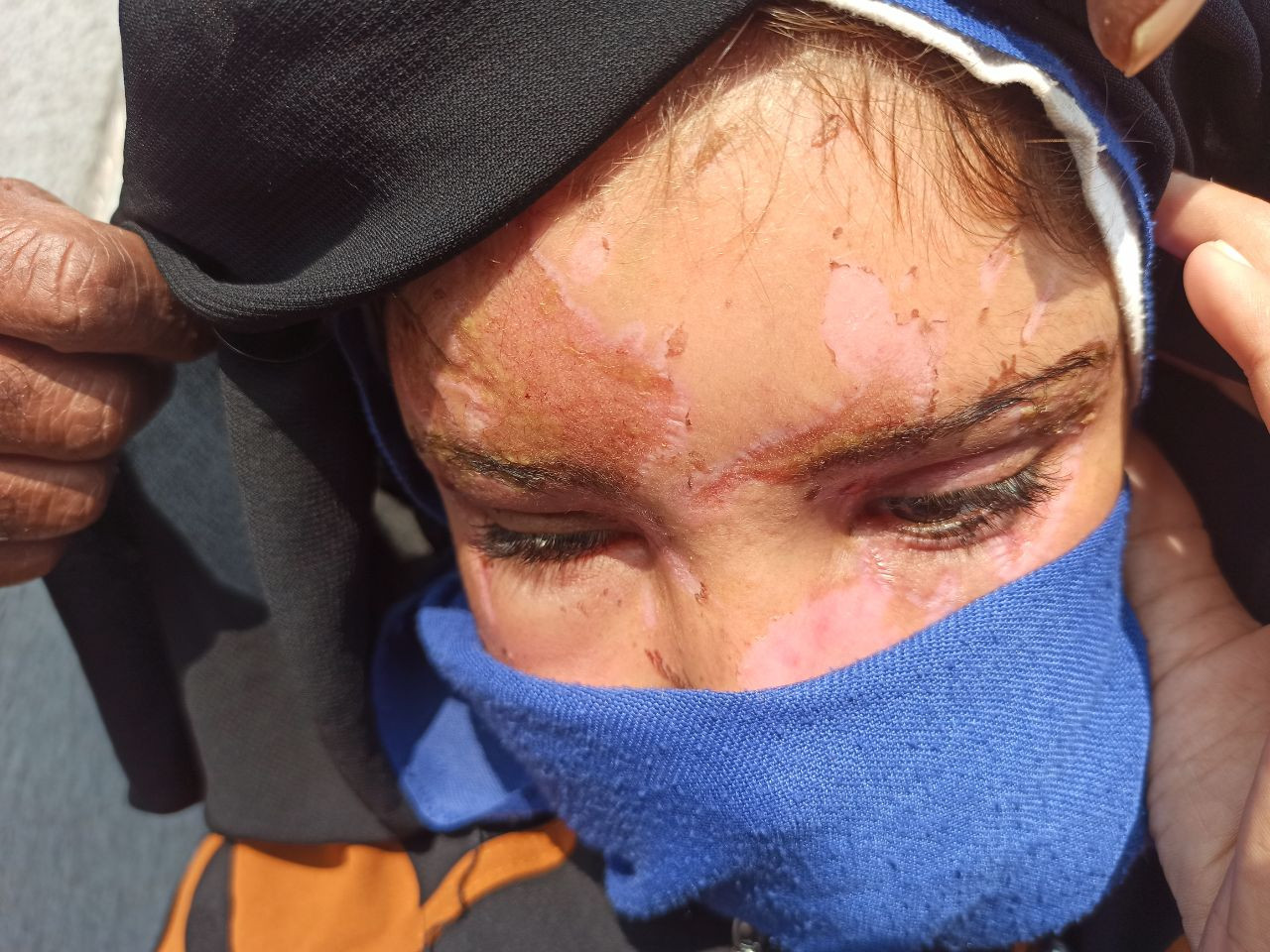 Mariam's face is covered with burns