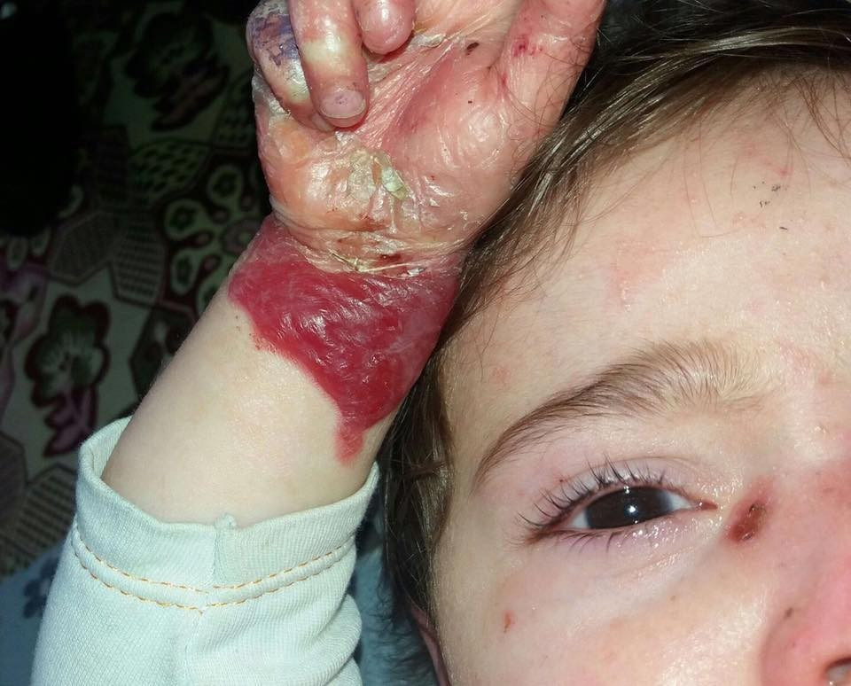 Two children suffering from hereditary pox disease