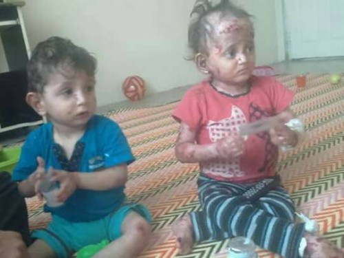 Treatment expenses for two siblings