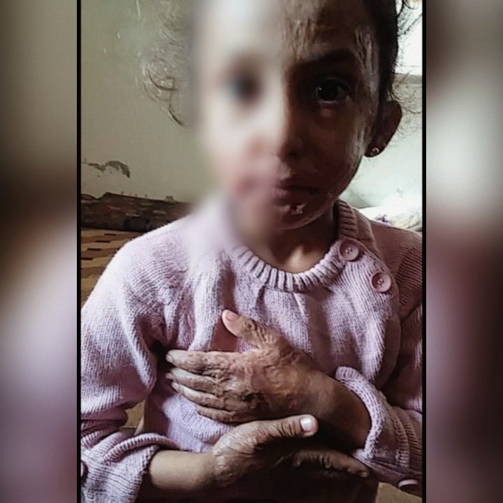 طفلة شوهتها صواريخ النابالم والفوسفور!