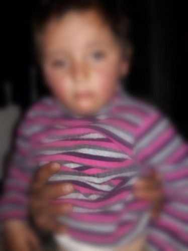 A child with brain cancer