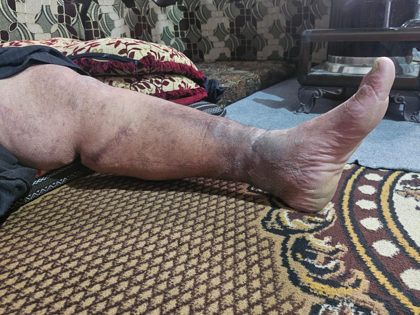 نازحٌ أنهكه النزوح والمرض