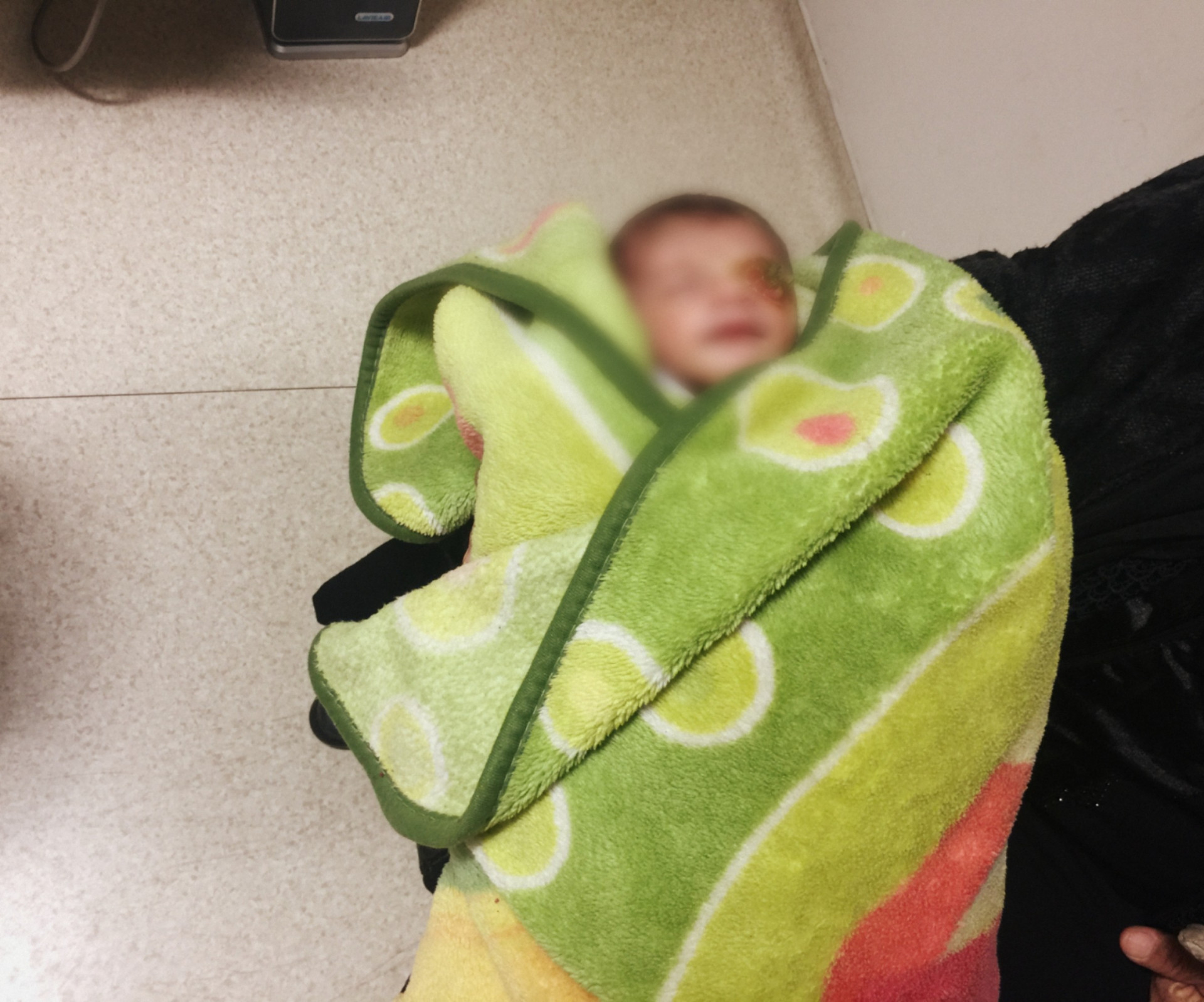newly born child with cancerous mass in the eye