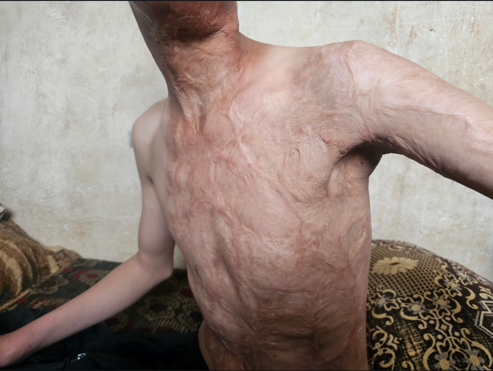 حروق تمنع أحمد من الخروج