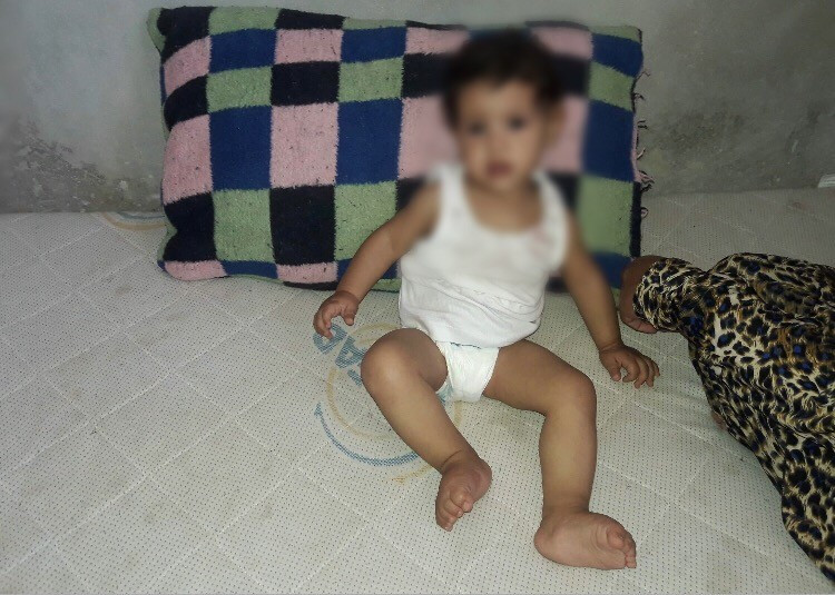 A girl with cerebral atrophy