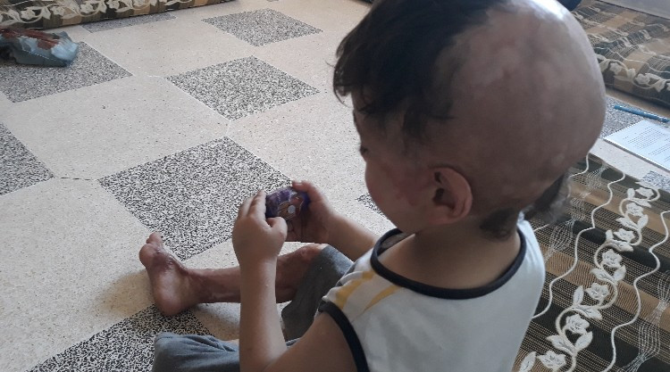 لم يكن صغر سنه شفيع له ألسنة اللهب التي شوهت جسده الهزيل