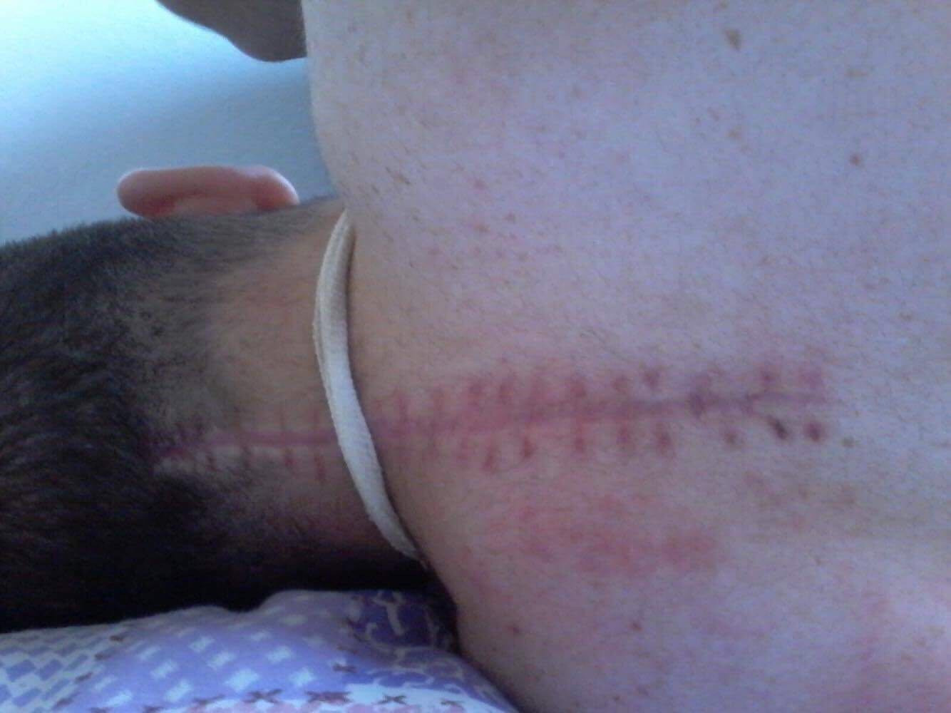 Young man suffering from a broken spine