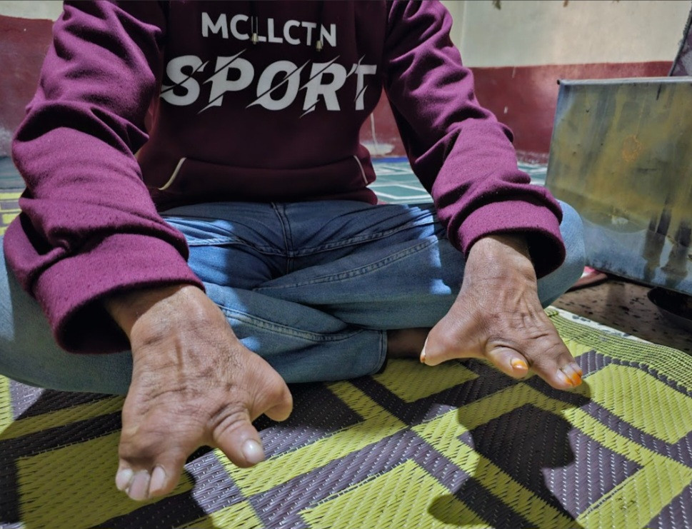 تشوّه ولادي يعيقه عن العمل