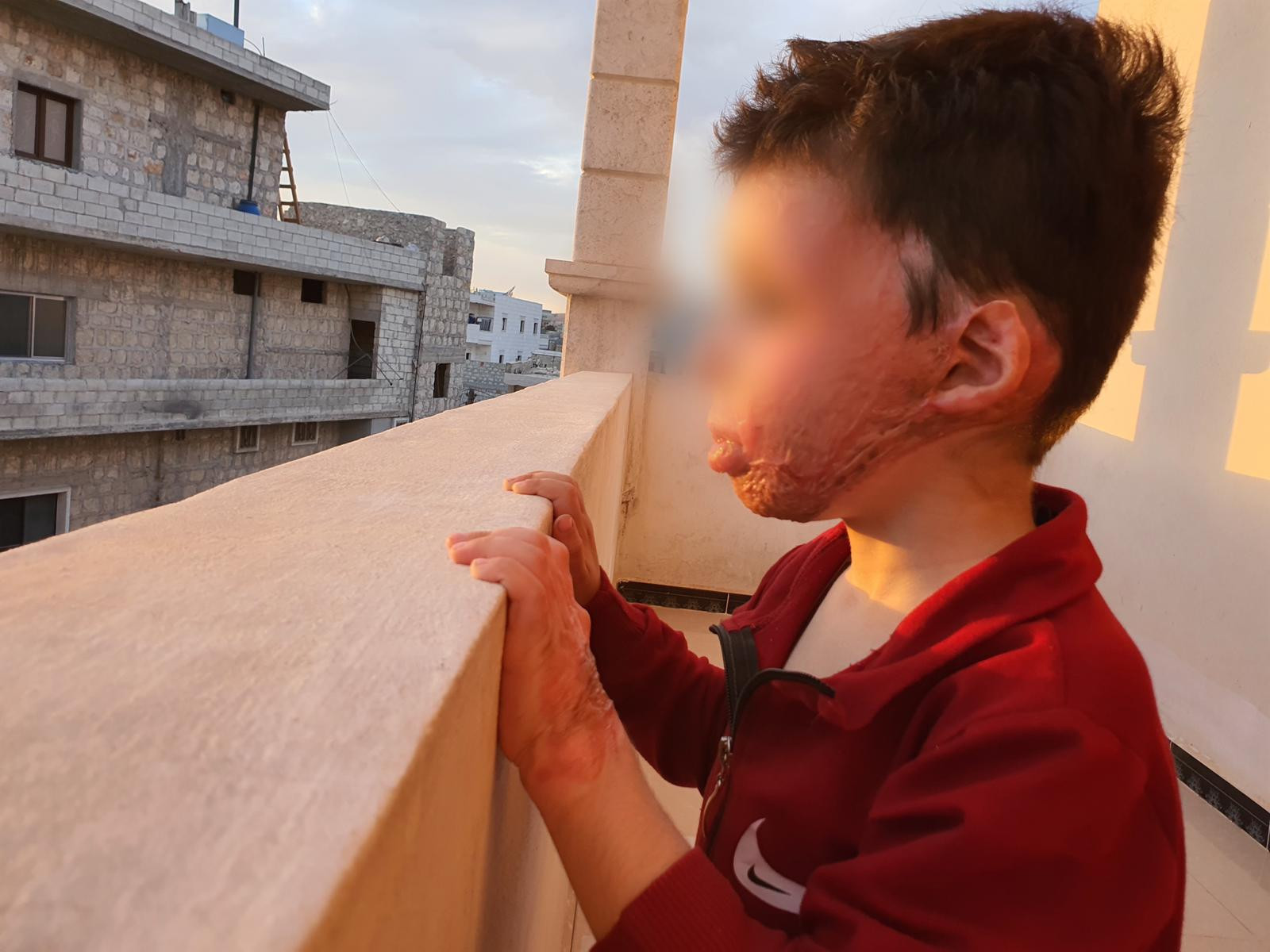 A small child suffering pain from burns