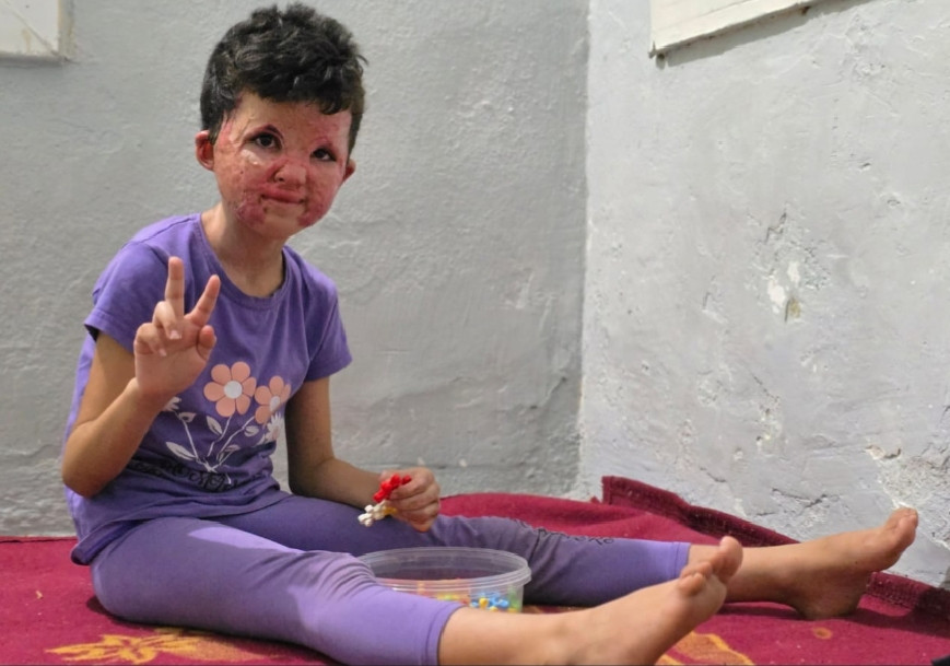 A fire stole away the innocence of her childhood face