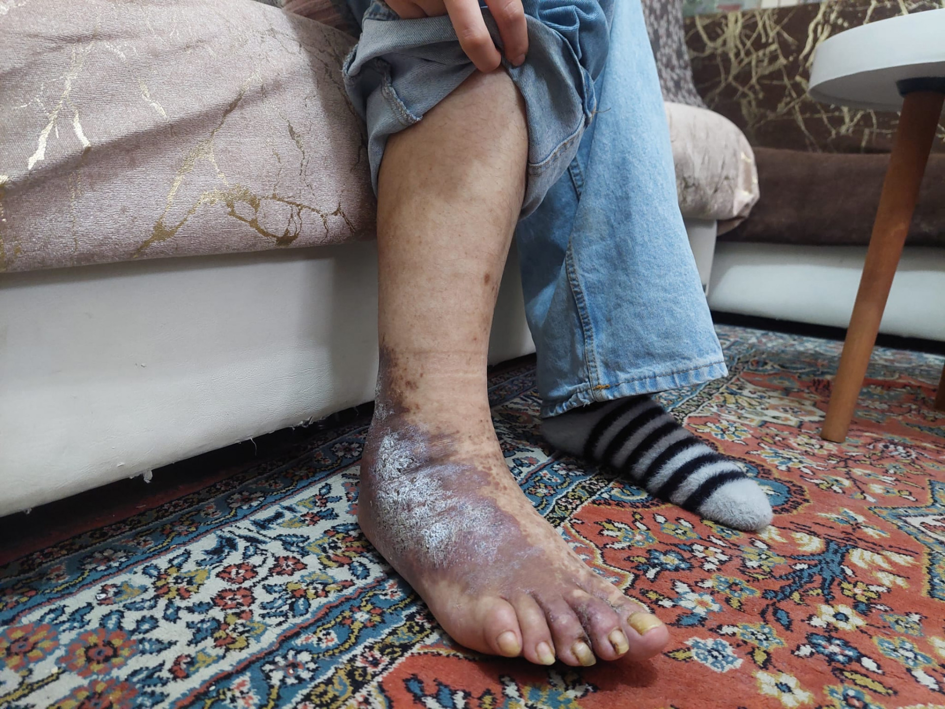 A Medical Shoe Could Help Little Limar Walk