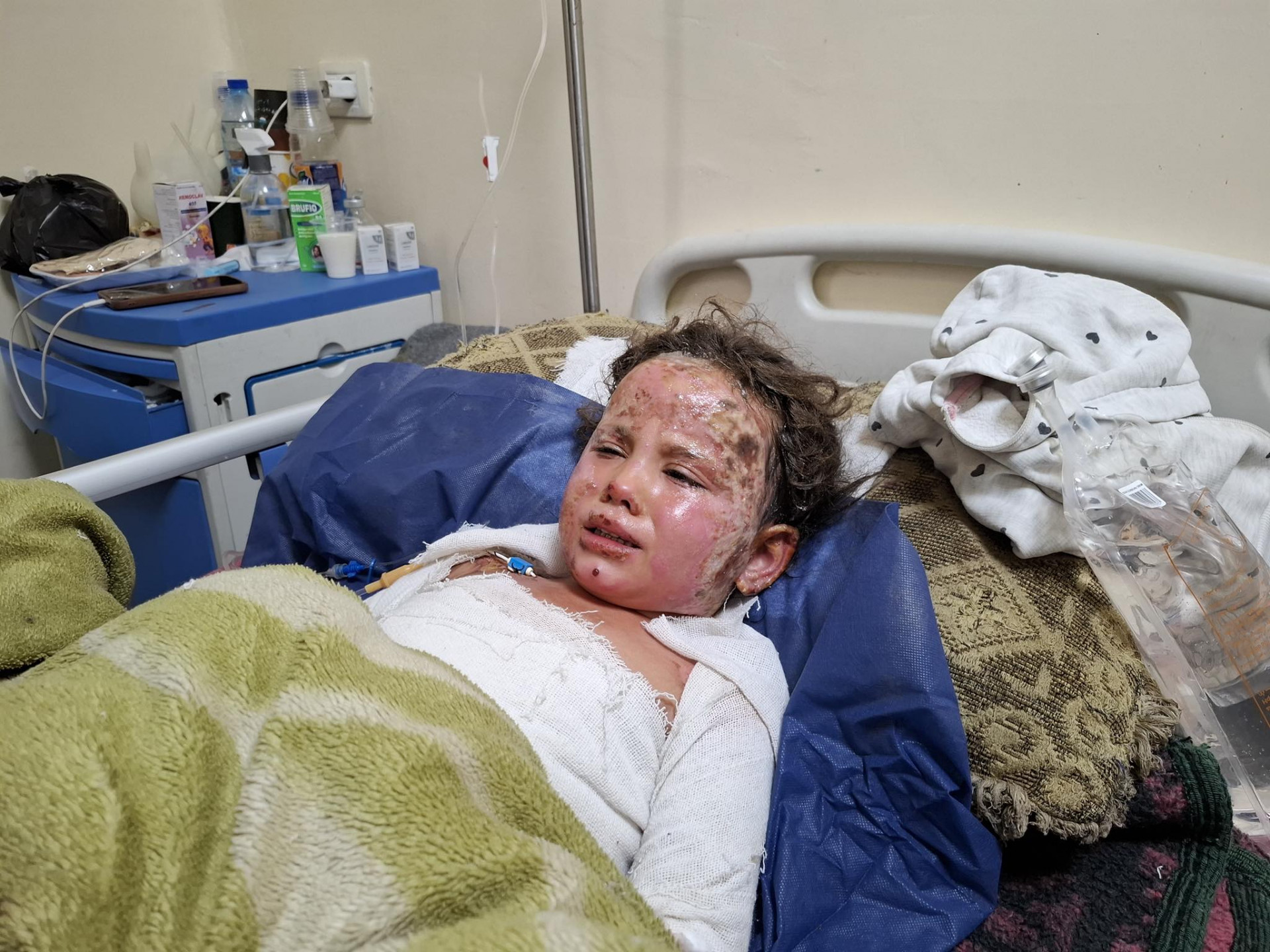 Kampagne zur Heilung von Brandverletzungen!