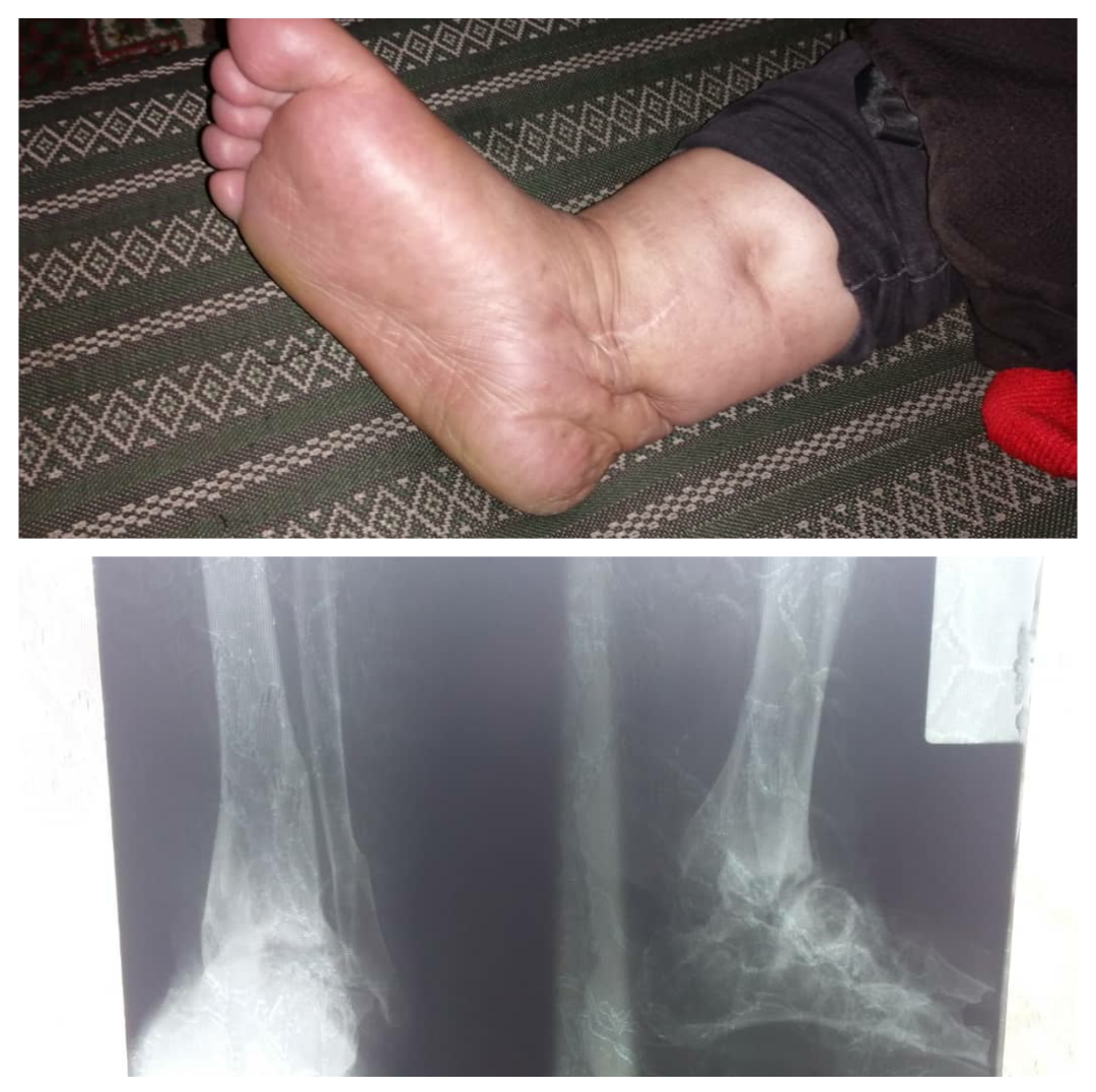 A woman with ankle injury