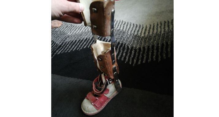 A Child with Congenital feet malformations!