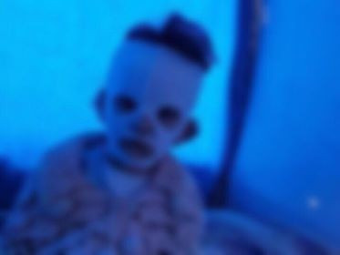 Child suffering from third degree burns