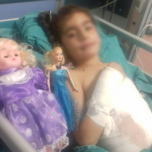A girl with severe burns