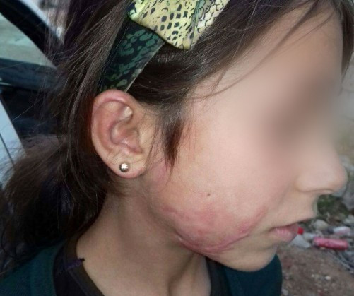 A little child suffers from burns