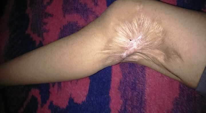 surgery is needed